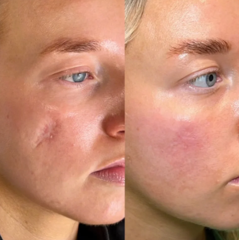 LuminYouth™ Silicon Scar Stick